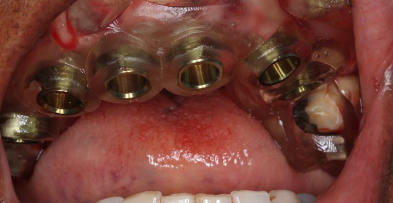 Cirurgia De Implantes Guiada Carga Imediata Inova Odontologia