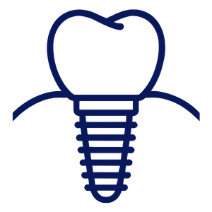 Implantes Dentários
